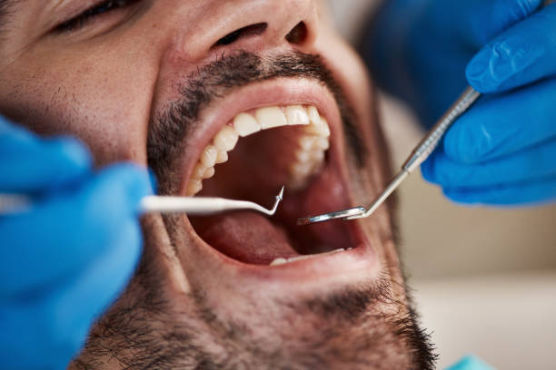 Best Emergency Treatment for Dental Infections or Abscesses in Simpsonville, SC