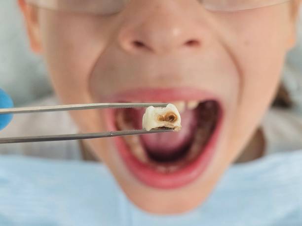 Best Emergency Wisdom Teeth Removal in Simpsonville, SC